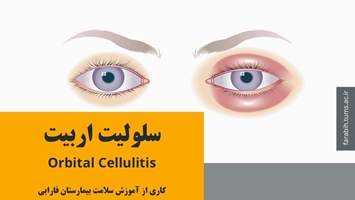 سلولیت اربیت و راه های درمان آن